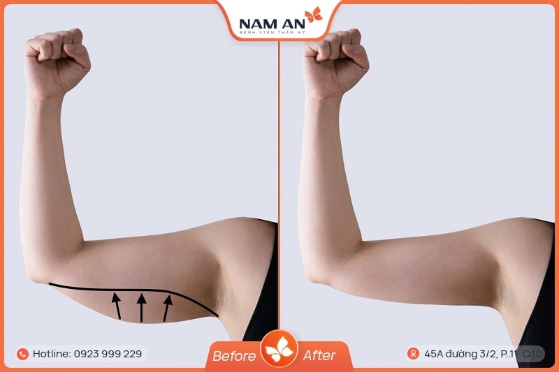 hình ảnh trước và sau khi hút mỡ bắp tay