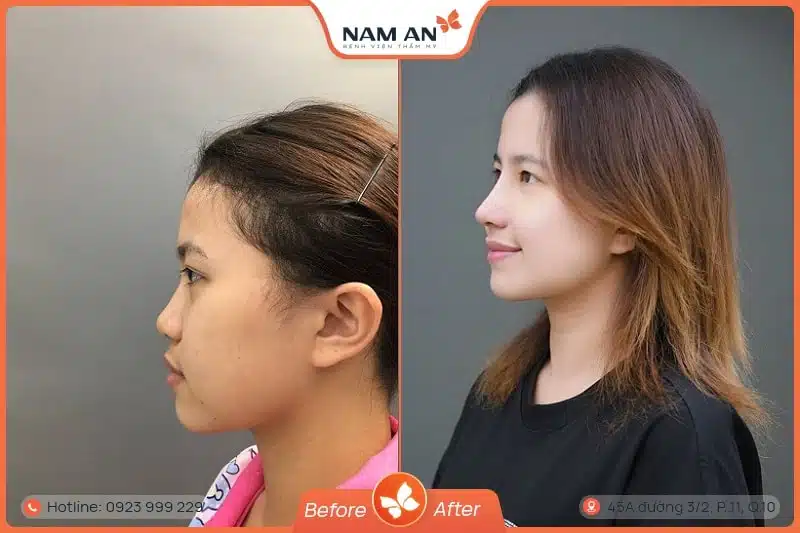 hình ảnh trước và sau khi nâng mũi sụn sườn