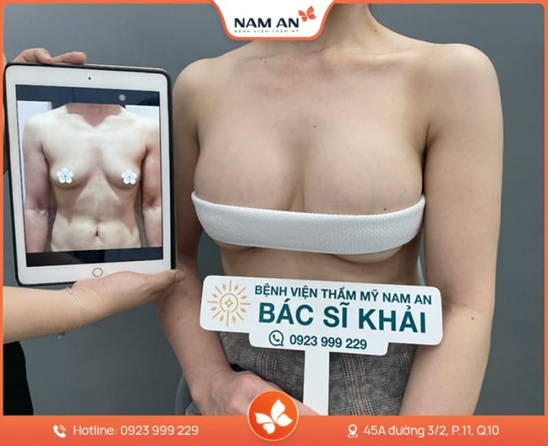 khách hàng việt kiều nâng ngực tại bệnh viện nam an