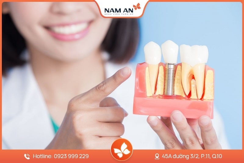 ưu điểm của phương pháp cấy răng implant