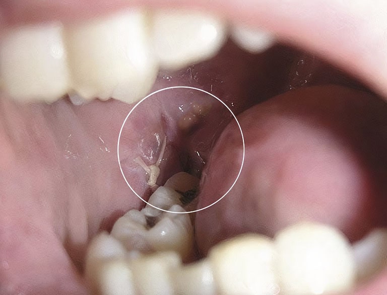 cách tránh nhiễm trùng sau khi nhổ răng khôn