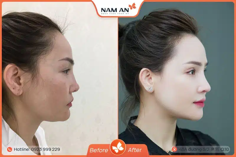 hình ảnh trước và sau khi nâng mũi s line