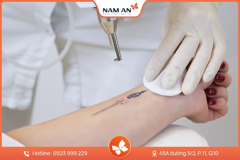 quy trình xóa xăm thẩm mỹ