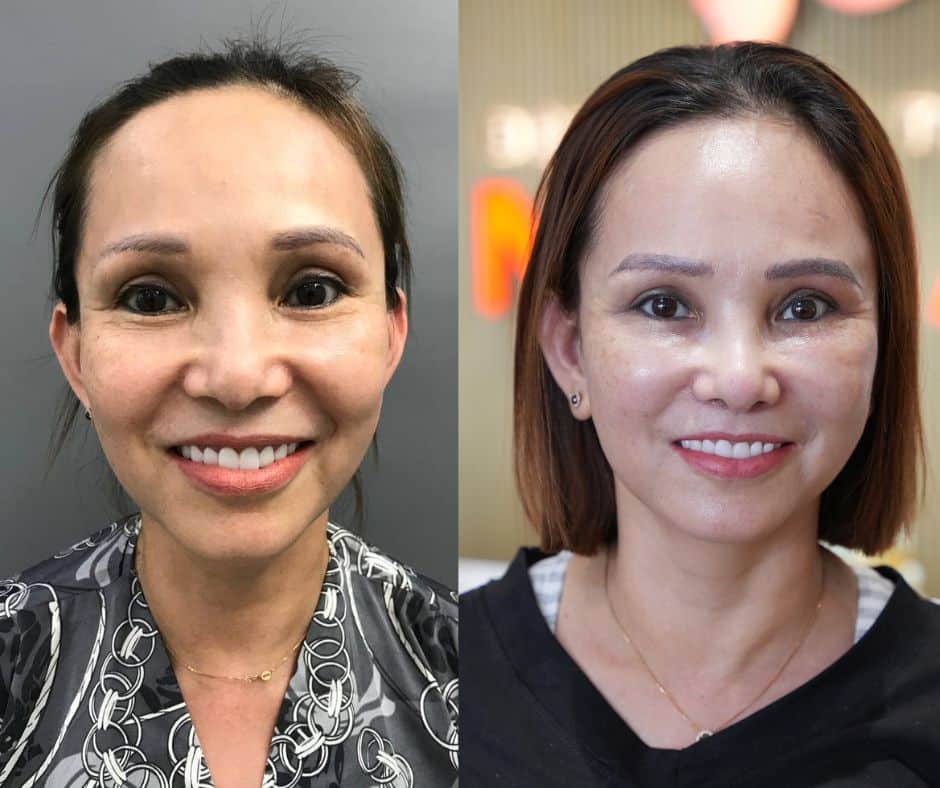 Cấy mỡ tự thân lên mặt