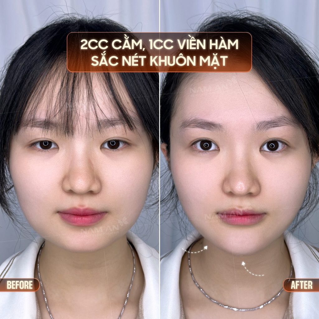 tiêm filler cằm+viền hàm