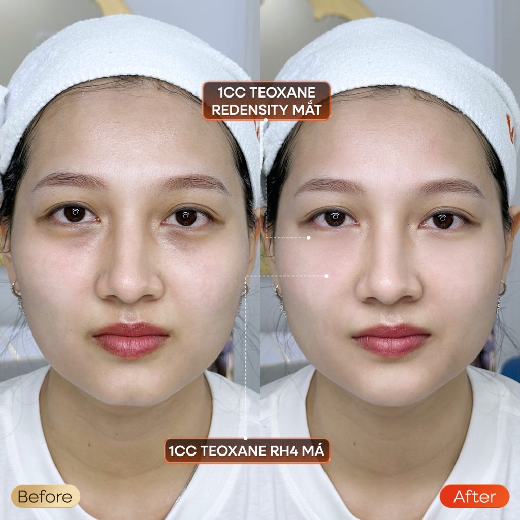 tiêm filler mắt+má