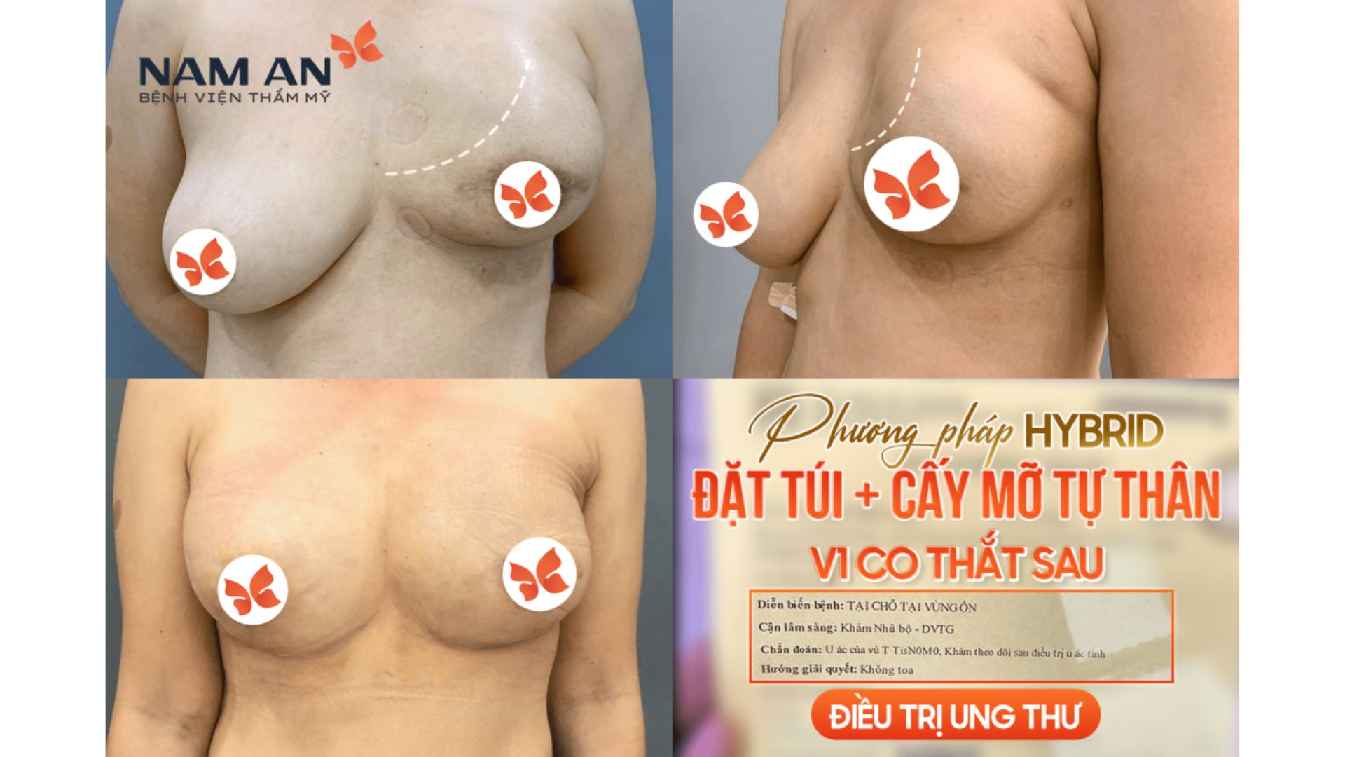 Báo Cáo Nghiên Cứu Cấy Mỡ Trong Phẫu Thuật Nâng Ngực (4)