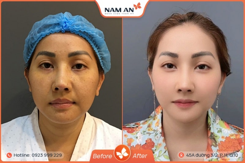 Các Biến Chứng Căng Da Mặt Và Cách Khắc Phục An Toàn (2)