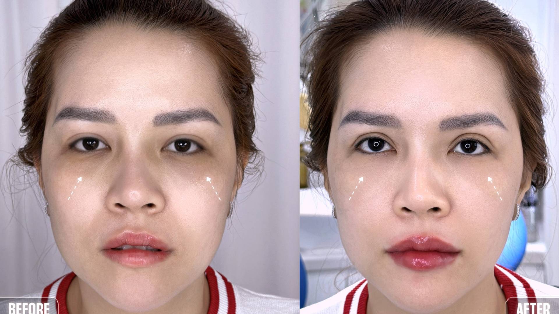 Cách Trị Thâm Quầng, Mắt Trũng Sâu Hiệu Quả Tại Nam An (1)