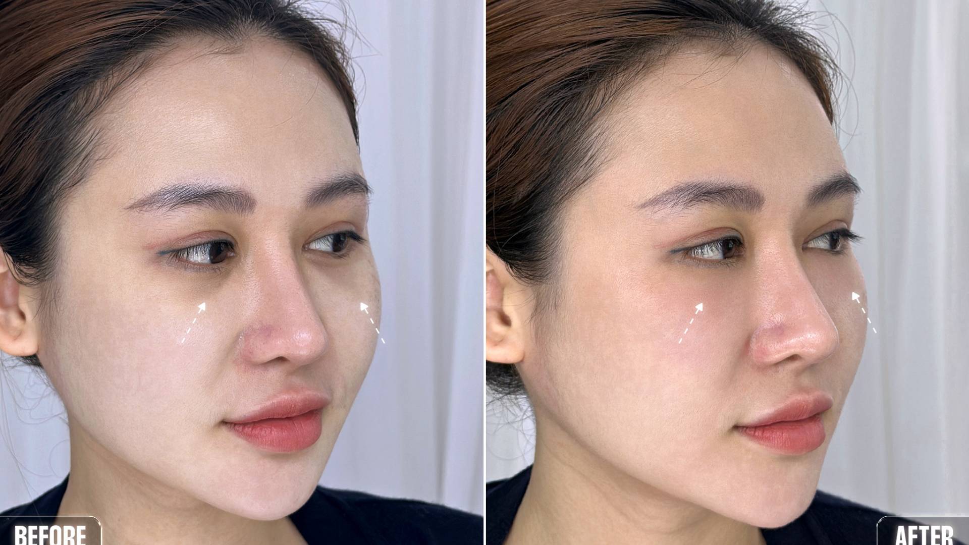 Cách Trị Thâm Quầng, Mắt Trũng Sâu Hiệu Quả Tại Nam An (2)