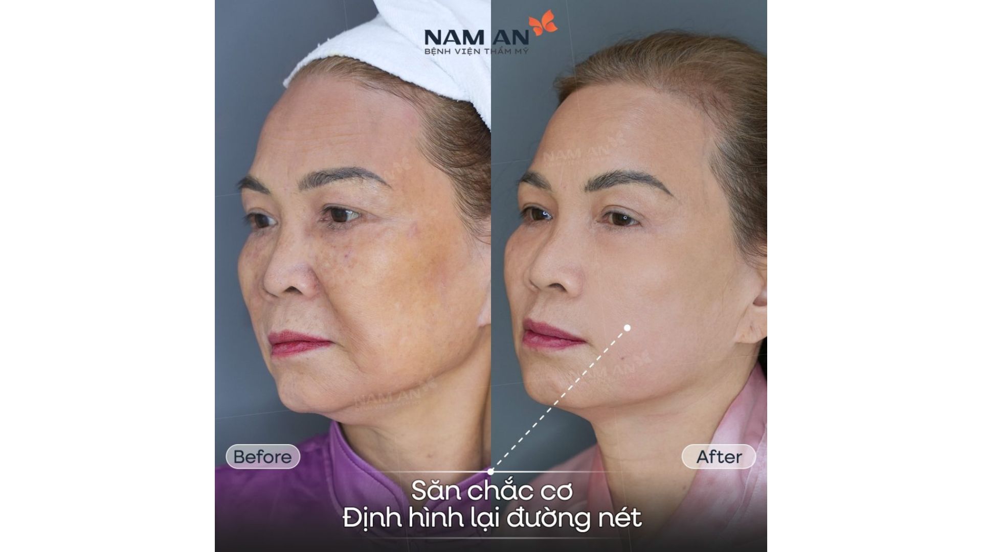 Căng Da Không Phẫu Thuật Với Ultherapy Prime Nam An (7)