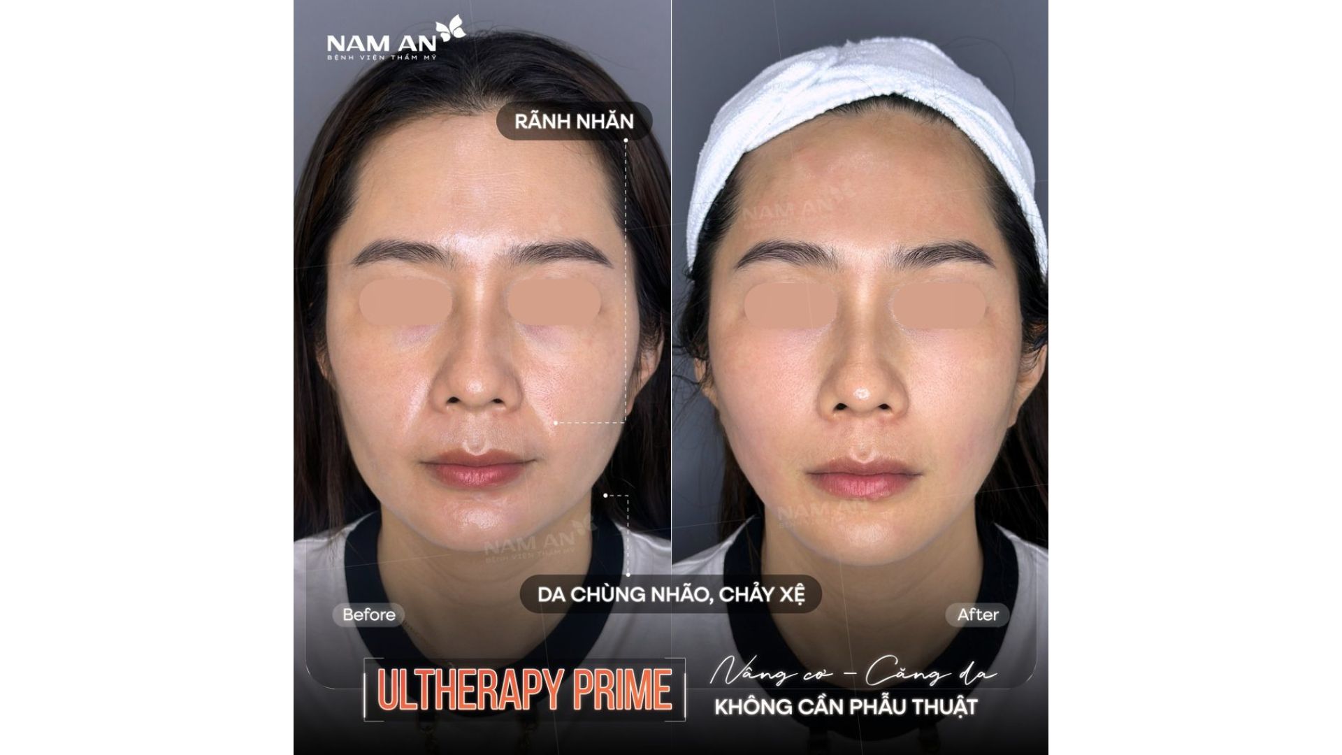 Căng Da Không Phẫu Thuật Với Ultherapy Prime Nam An (8)
