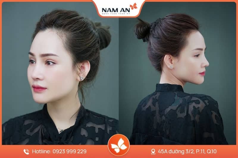 Căng Da Mặt Mini Midface Trẻ Hóa Tầng Giữa Tại Nam An (4)