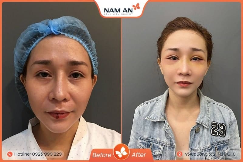 Căng Da Mặt Mini Midface Trẻ Hóa Tầng Giữa Tại Nam An (6)