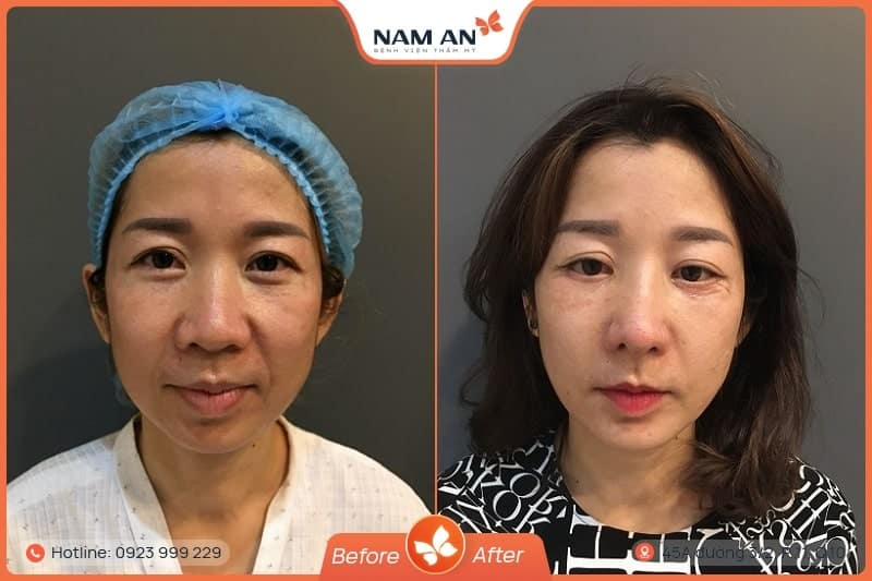 Căng Da Mặt Mini Midface Trẻ Hóa Tầng Giữa Tại Nam An (8)