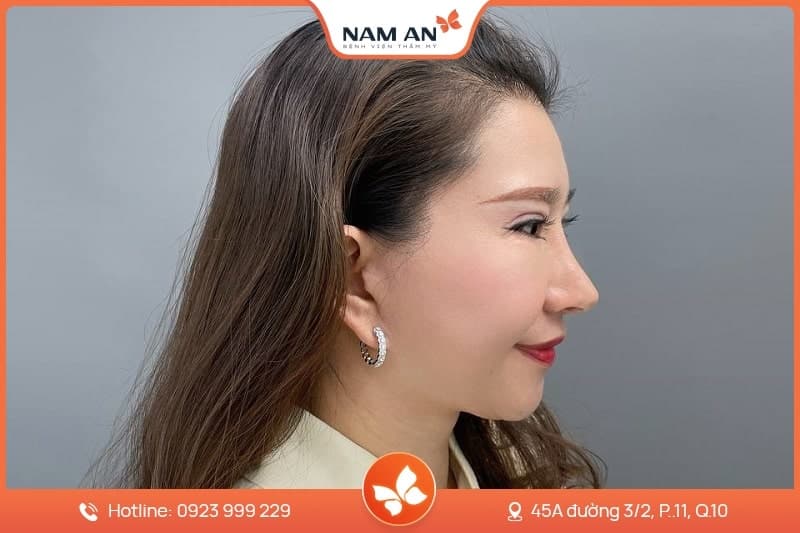 Căng Da Mặt Mini Midface Trẻ Hóa Tầng Giữa Tại Nam An