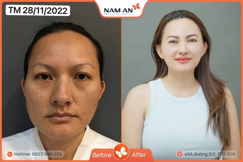 Căng Da Mặt Nội Soi Endoface Toàn Diện Tại BVTM Nam An (6)