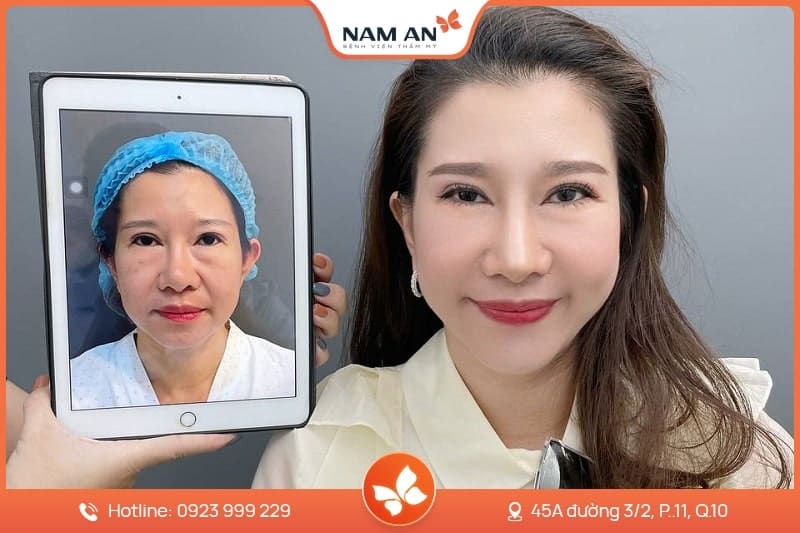 Căng Da Mặt Nội Soi Endoface Toàn Diện Tại BVTM Nam An (7)