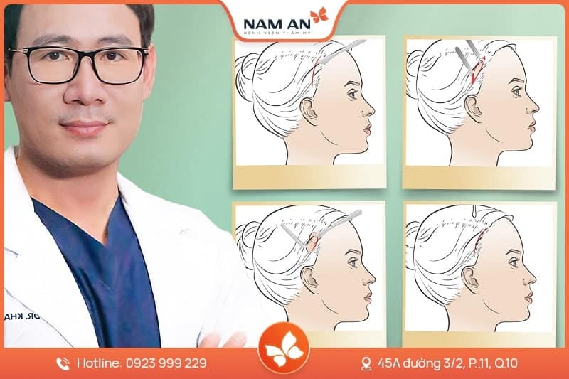 Căng Da Mặt Nội Soi Endoface Toàn Diện Tại BVTM Nam An (9)
