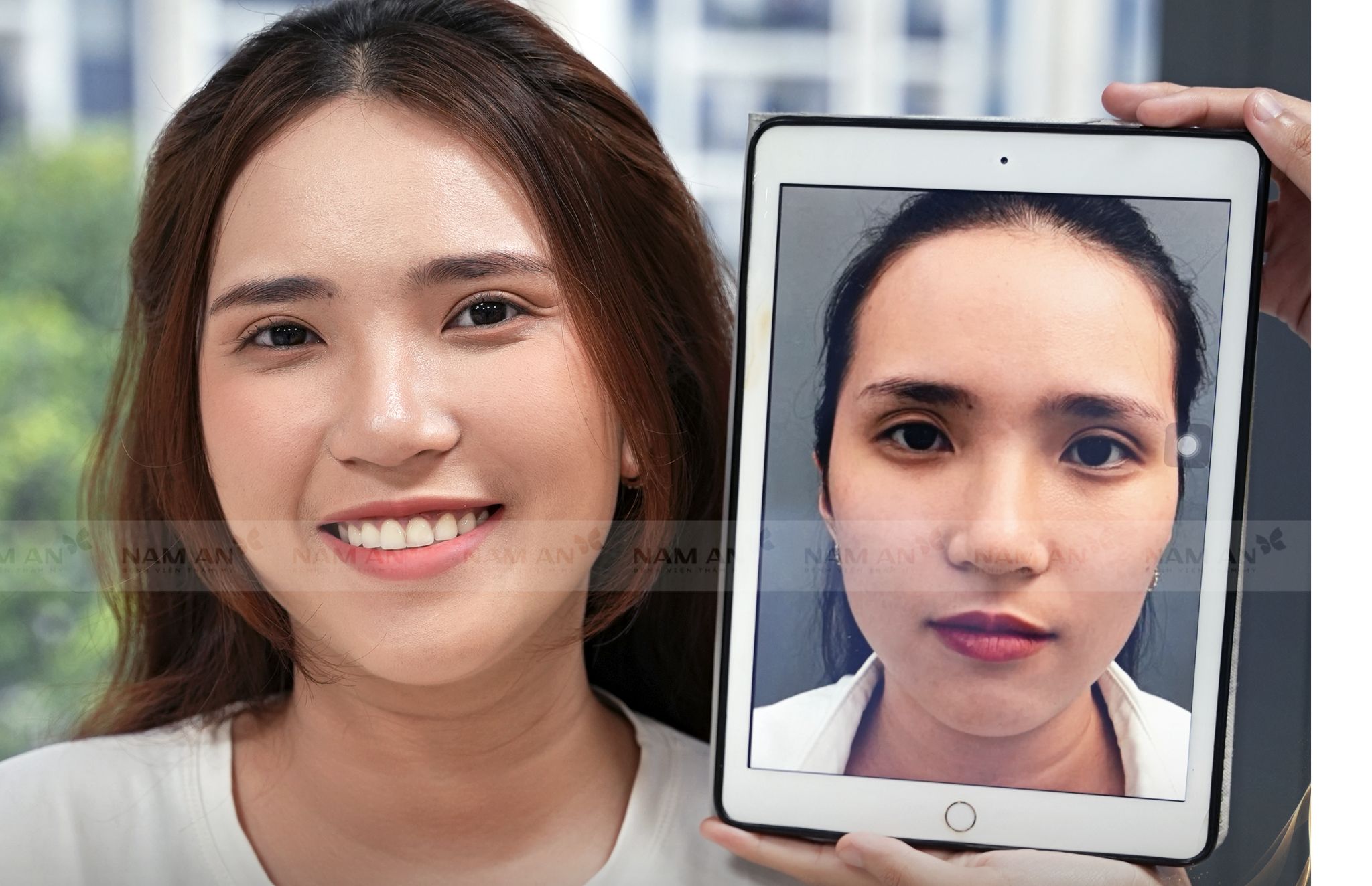 Cắt Mí Hỏng Có Sửa Được Không Bao Lâu Sửa Lại Được (2)