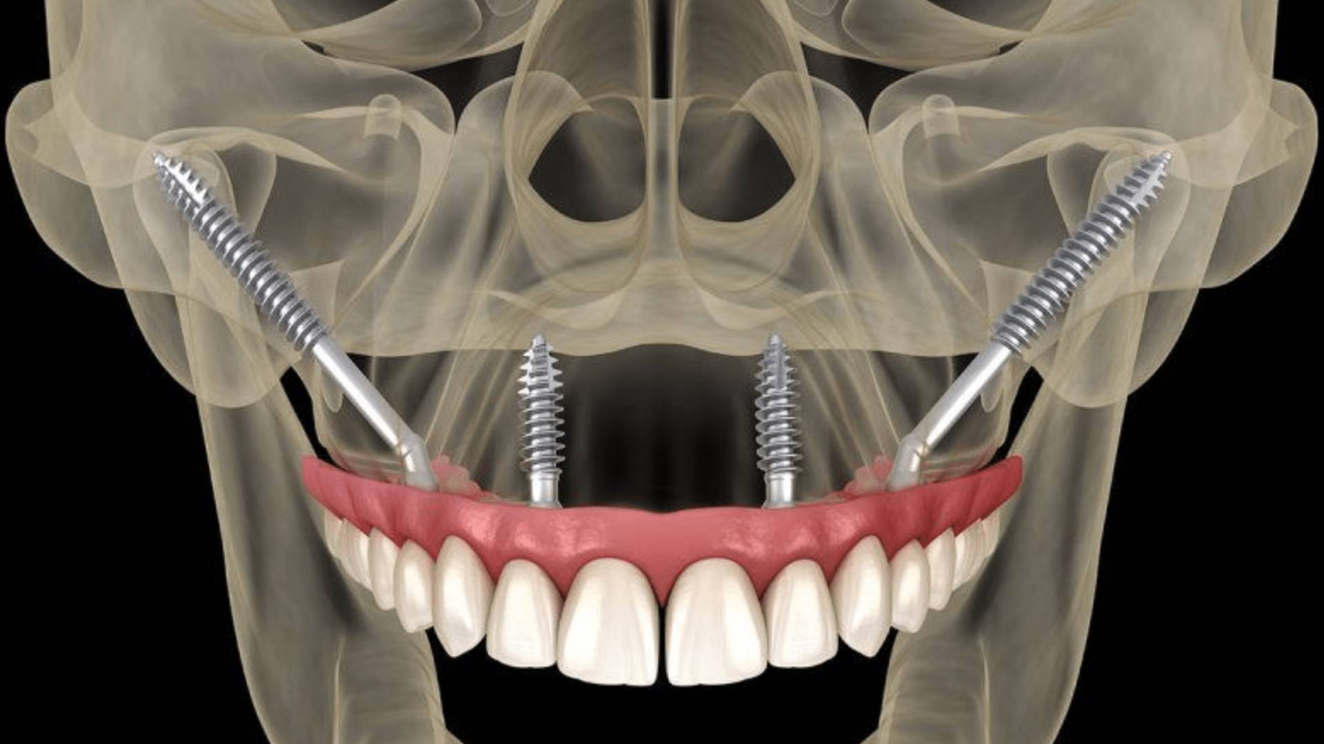 Cấy Ghép Implant Giải Pháp Phục Hồi Răng Mất Hiệu Quả (2)