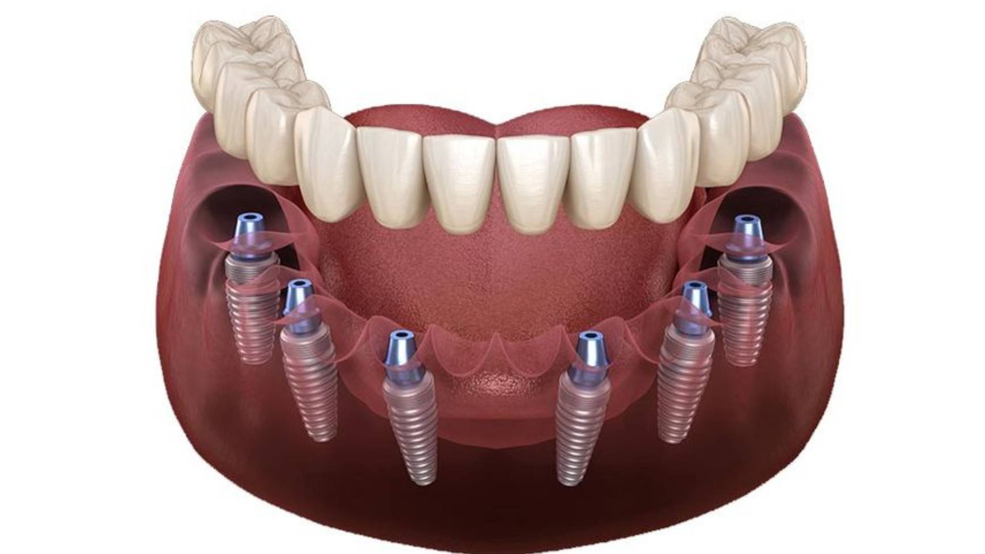 Cấy Ghép Implant Giải Pháp Phục Hồi Răng Mất Hiệu Quả (3)