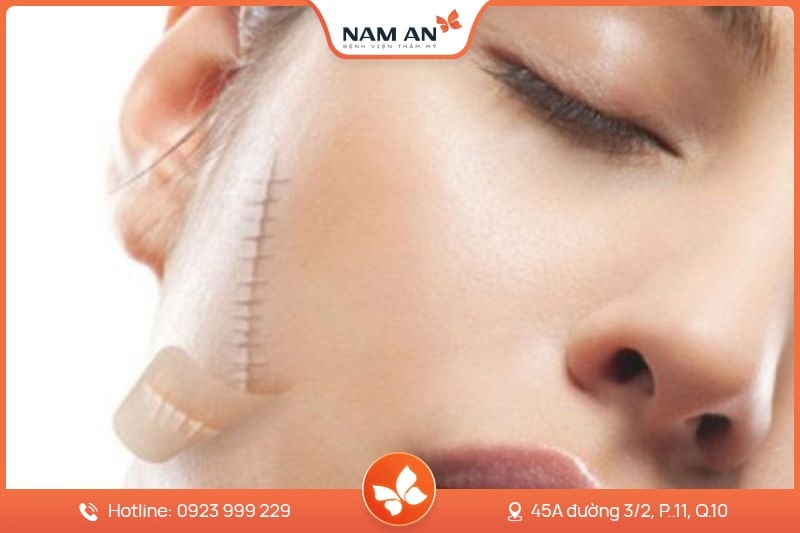 Chỉnh Sửa Căng Da Mặt Bị Hỏng Uy Tín Tại BVTM Nam An (2)