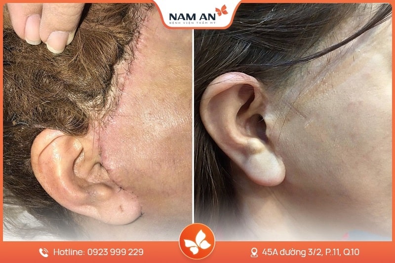 Chỉnh Sửa Căng Da Mặt Bị Hỏng Uy Tín Tại BVTM Nam An (4)