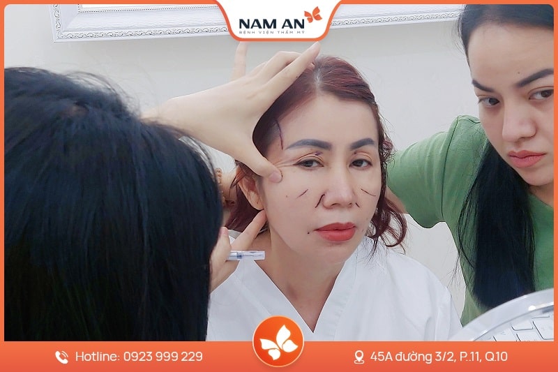 Chỉnh Sửa Căng Da Mặt Bị Hỏng Uy Tín Tại BVTM Nam An (5)