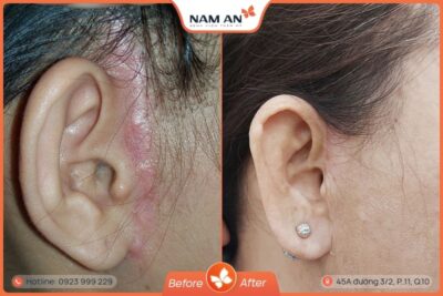 Chỉnh Sửa Căng Da Mặt Bị Hỏng Uy Tín Tại BVTM Nam An