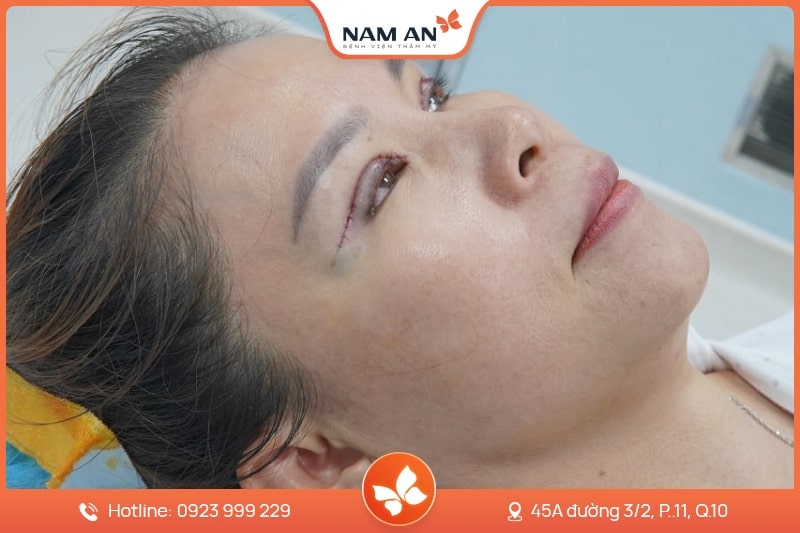 Chỉnh Sửa Mí Mắt Bị Hỏng Uy Tín Tại BV Thẩm Mỹ Nam An (3)