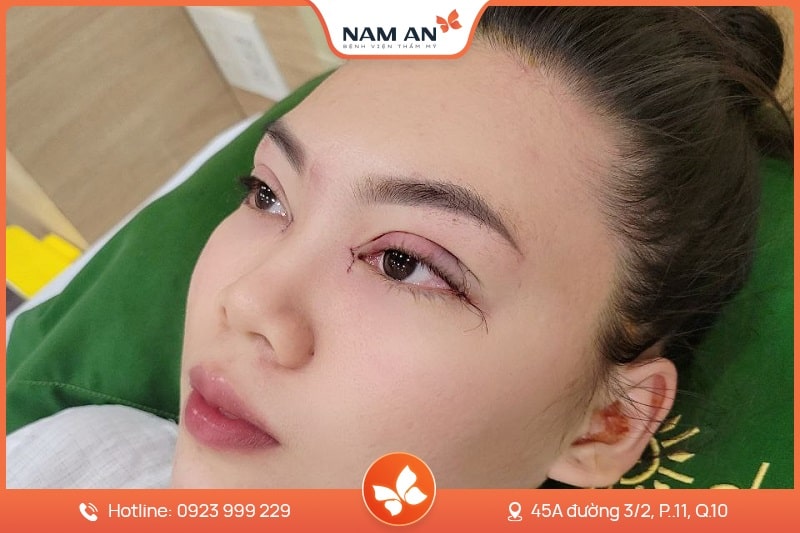 Chỉnh Sửa Mí Mắt Bị Hỏng Uy Tín Tại BV Thẩm Mỹ Nam An (3)