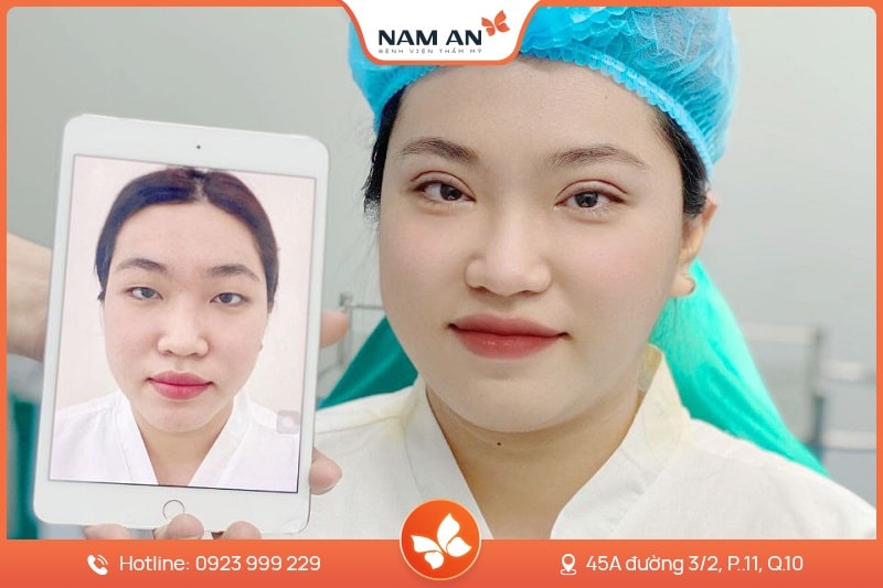 Chỉnh Sửa Mí Mắt Bị Hỏng Uy Tín Tại BV Thẩm Mỹ Nam An (3)