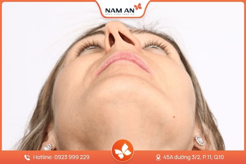 Chỉnh Sửa Mũi Hỏng Co Rút, Biến Dạng Tại BVTM Nam An (10)