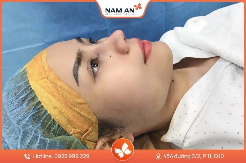 Chỉnh Sửa Mũi Hỏng Co Rút, Biến Dạng Tại BVTM Nam An (3)