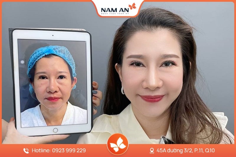 Chỉnh Sửa Mũi Hỏng Co Rút, Biến Dạng Tại BVTM Nam An (4)