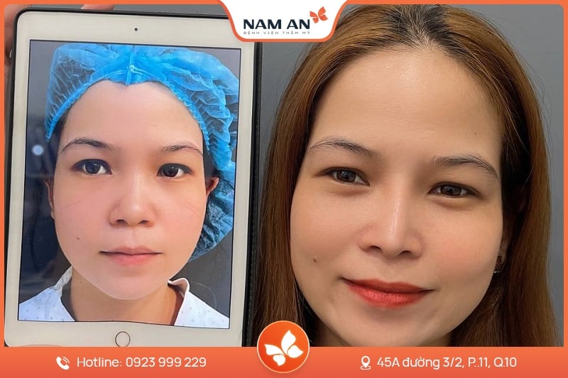 Chỉnh Sửa Mũi Hỏng Co Rút, Biến Dạng Tại BVTM Nam An (5)