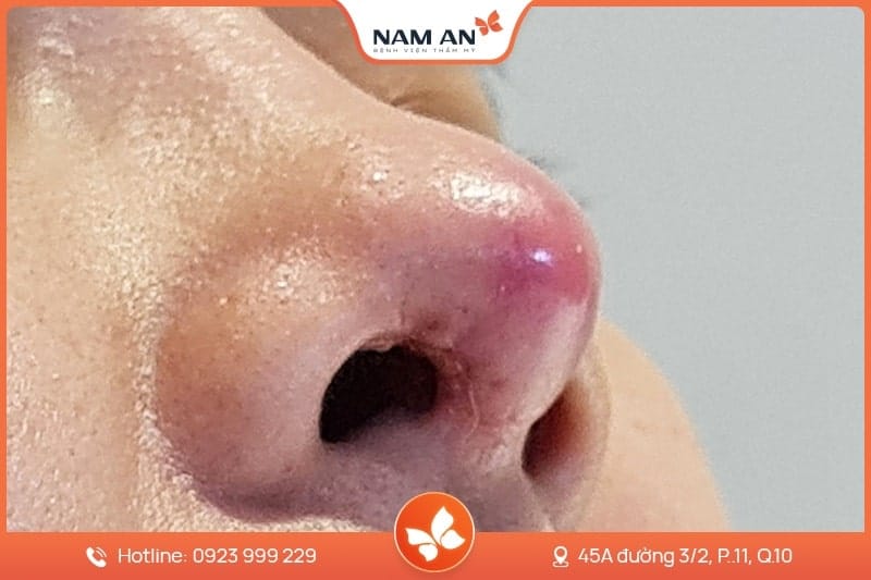 Chỉnh Sửa Mũi Hỏng Co Rút, Biến Dạng Tại BVTM Nam An (8)