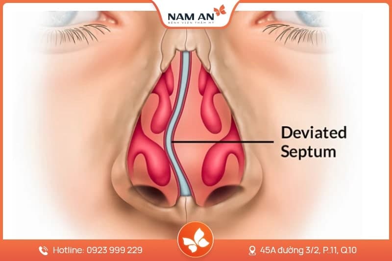 Chỉnh Sửa Mũi Hỏng Co Rút, Biến Dạng Tại BVTM Nam An (9)