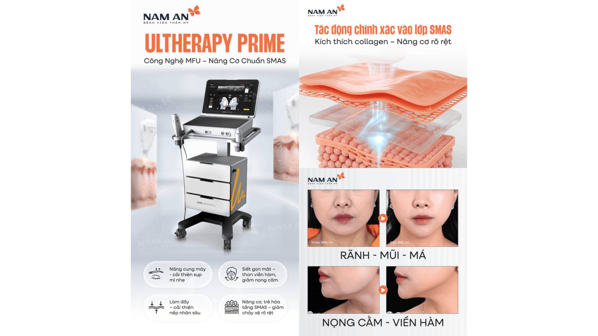Chọn Thermage FLX Hay Ultherapy Prime Để Làm Đẹp Đón Tết (5)