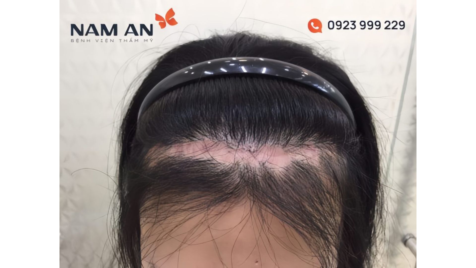 Có Nên Phẫu Thuật Hạ Đường Chân Tóc Không (2)