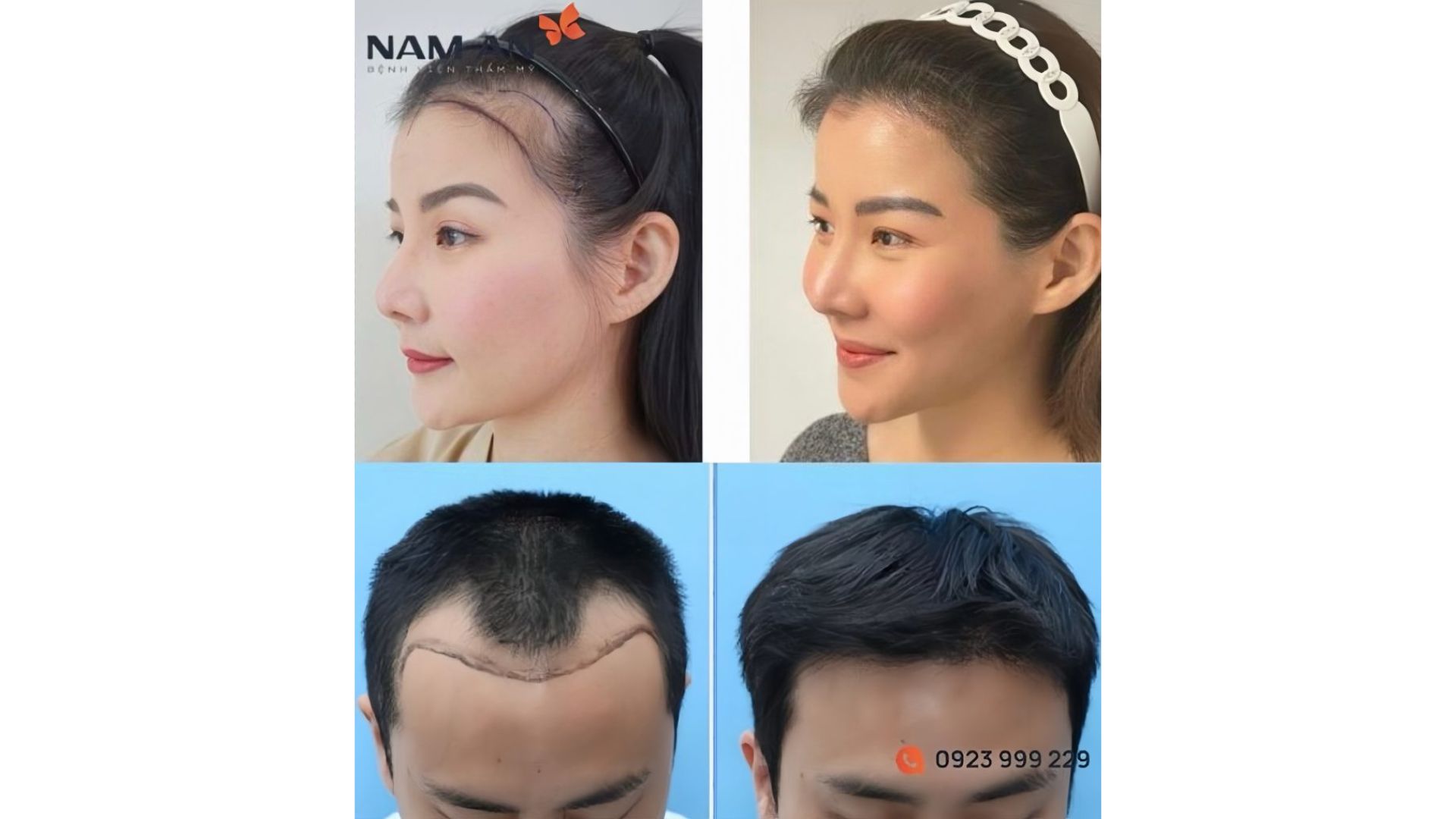 Có Nên Phẫu Thuật Hạ Đường Chân Tóc Không (5)