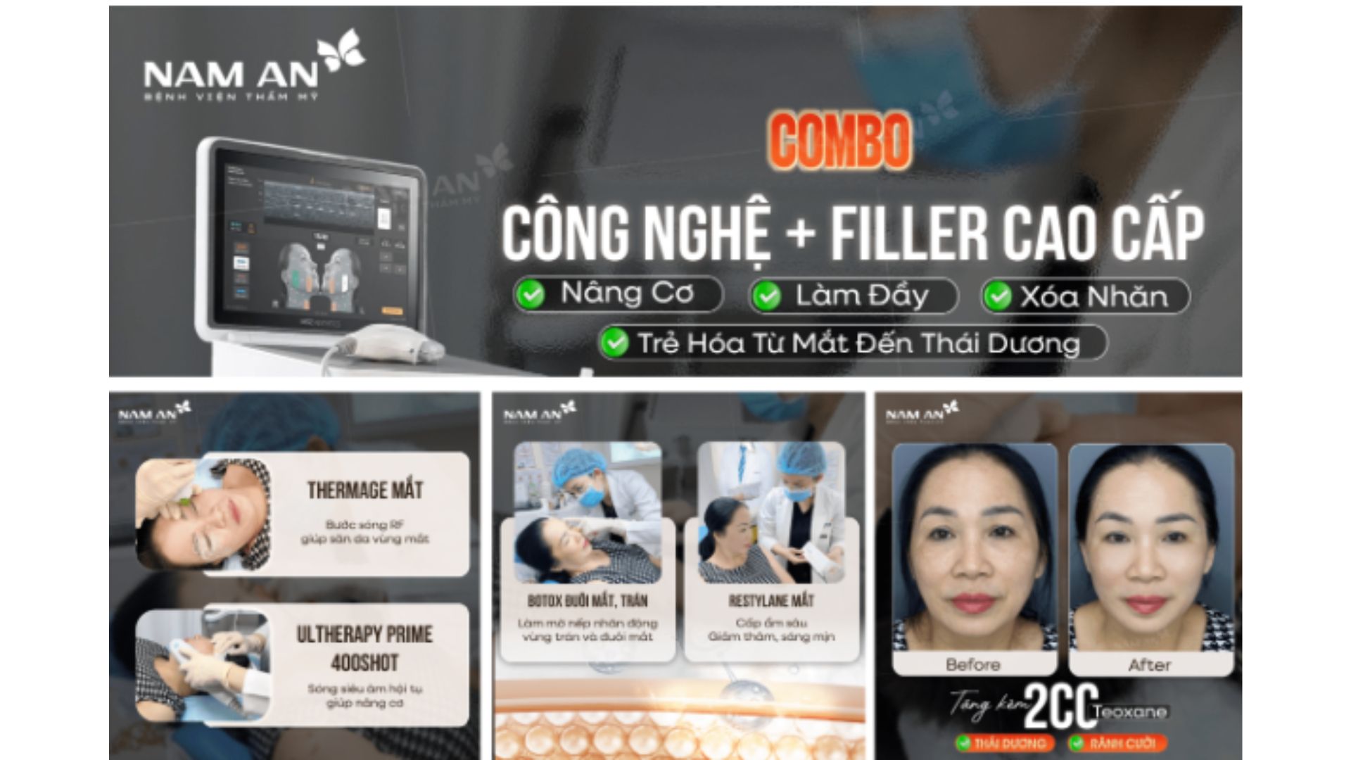 Combo thực hiện trẻ hóa tự nhiên, Ultherapy Prime – Thermage FLX – Botox – Filler (1)