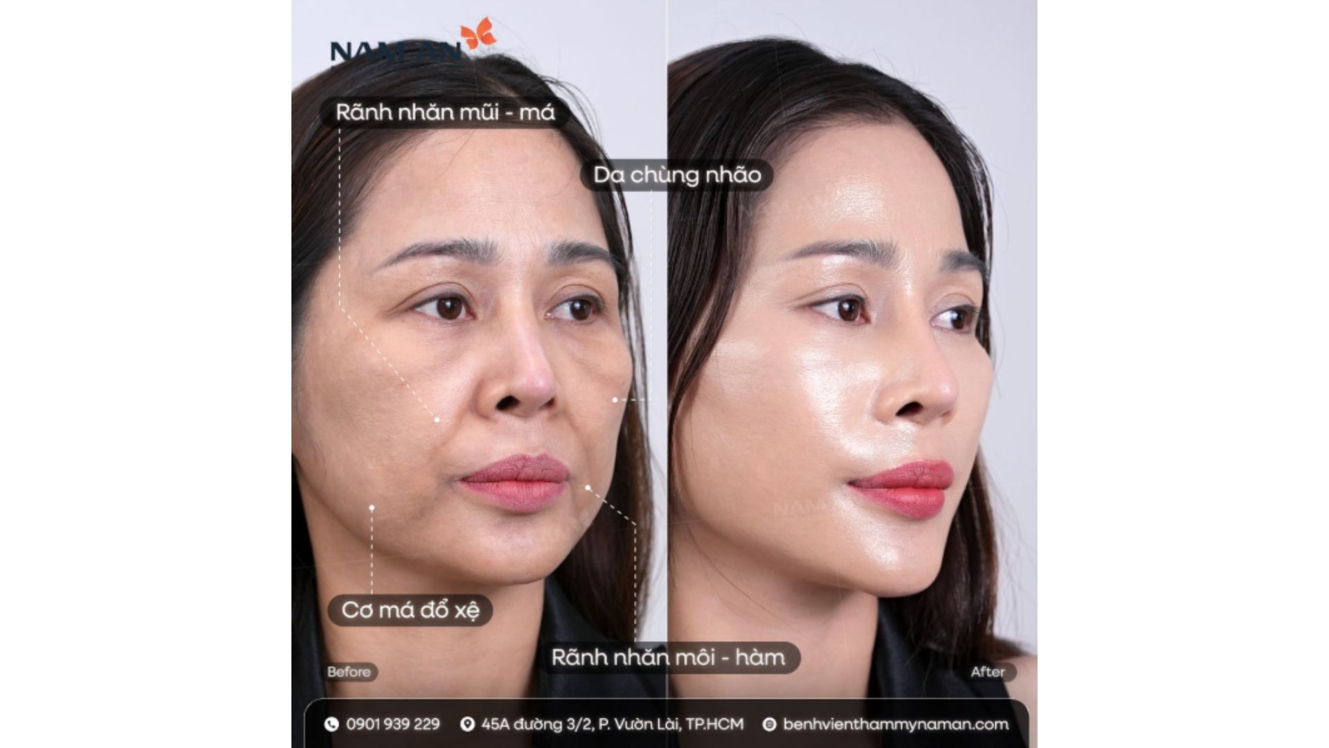 Combo thực hiện trẻ hóa tự nhiên, Ultherapy Prime – Thermage FLX – Botox – Filler (2)