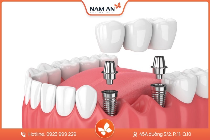 Dịch Vụ Cấy Ghép Trồng Răng Implant Uy Tín Tại Nam An (3)