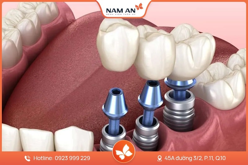 Dịch Vụ Cấy Ghép Trồng Răng Implant Uy Tín Tại Nam An (3)