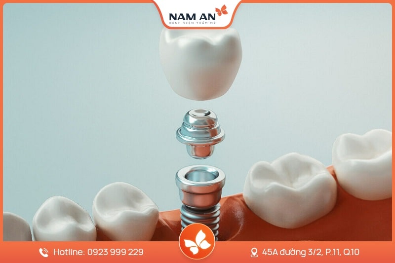 Dịch Vụ Cấy Ghép Trồng Răng Implant Uy Tín Tại Nam An (3)