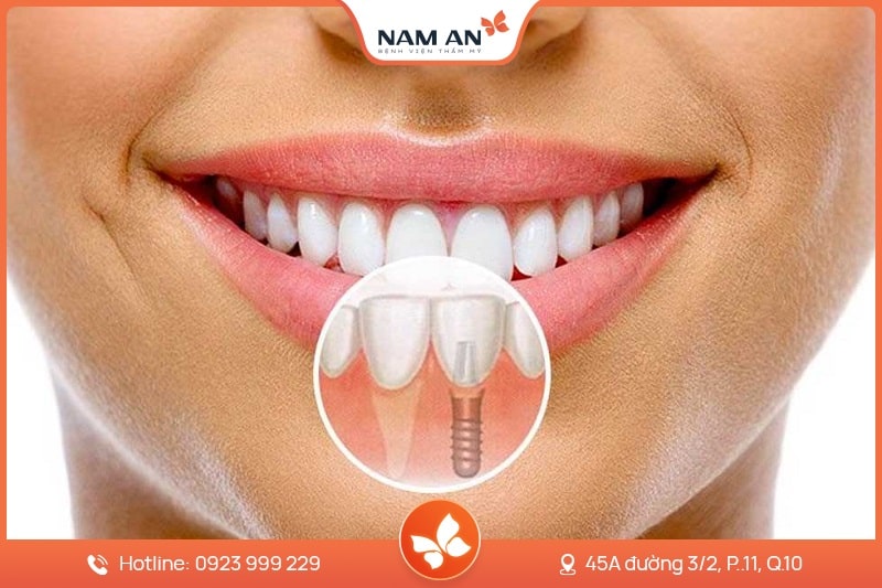 Dịch Vụ Cấy Ghép Trồng Răng Implant Uy Tín Tại Nam An (3)