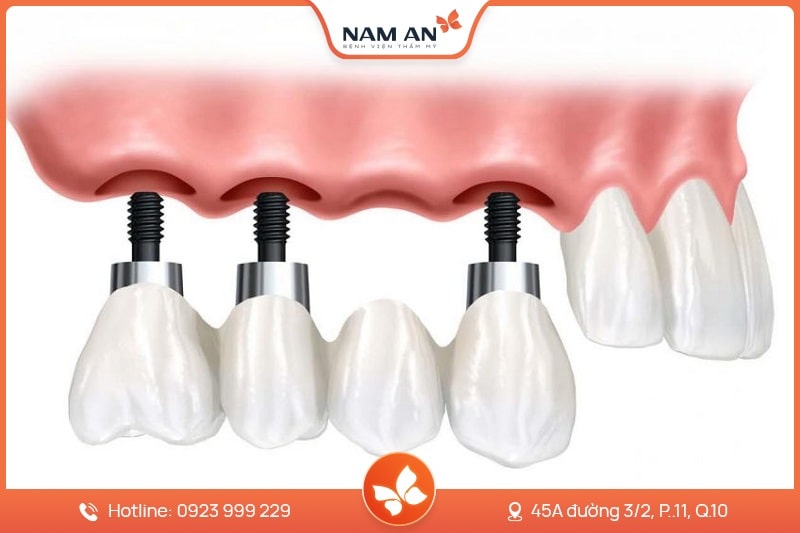 Dịch Vụ Cấy Ghép Trồng Răng Implant Uy Tín Tại Nam An (3)