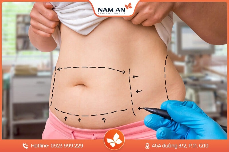Dịch Vụ Hút Mỡ Toàn Thân An Toàn Tại BVTM Nam An (10)
